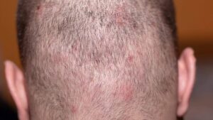 pimples on scalp