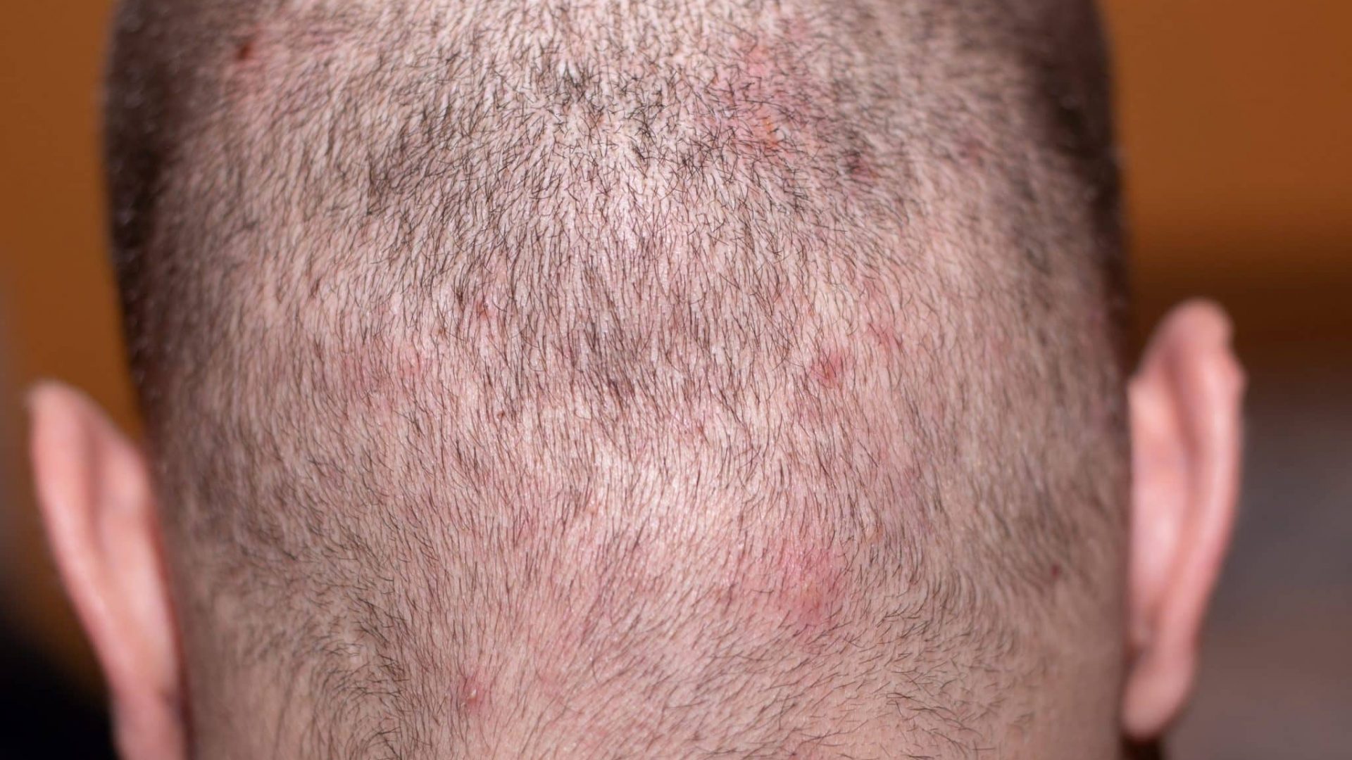 pimples on scalp