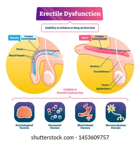 The treatment that has gained recognition is Duratia 90, a higher-dose dapoxetine tablet that helps delay ejaculation and extend intimacy.